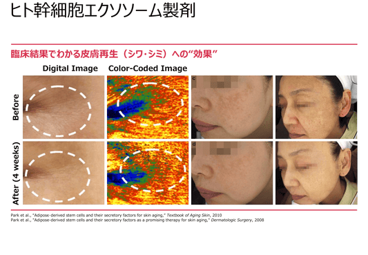 エクソソーム原液5回分+40mlクリーム2本