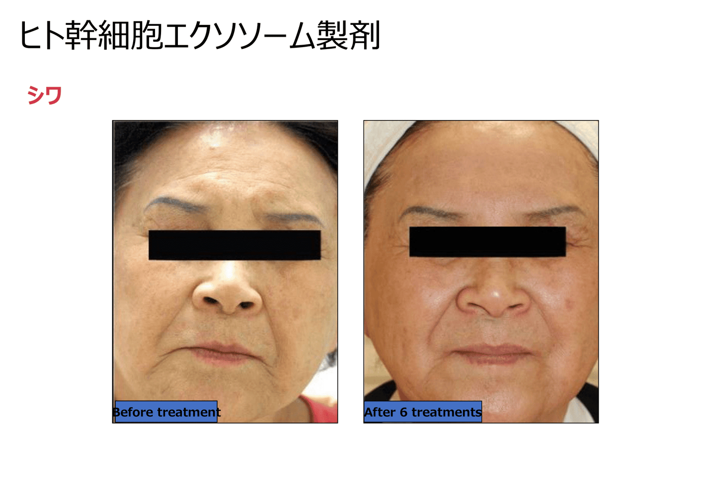 エクソソーム原液5回分+40mlクリーム2本