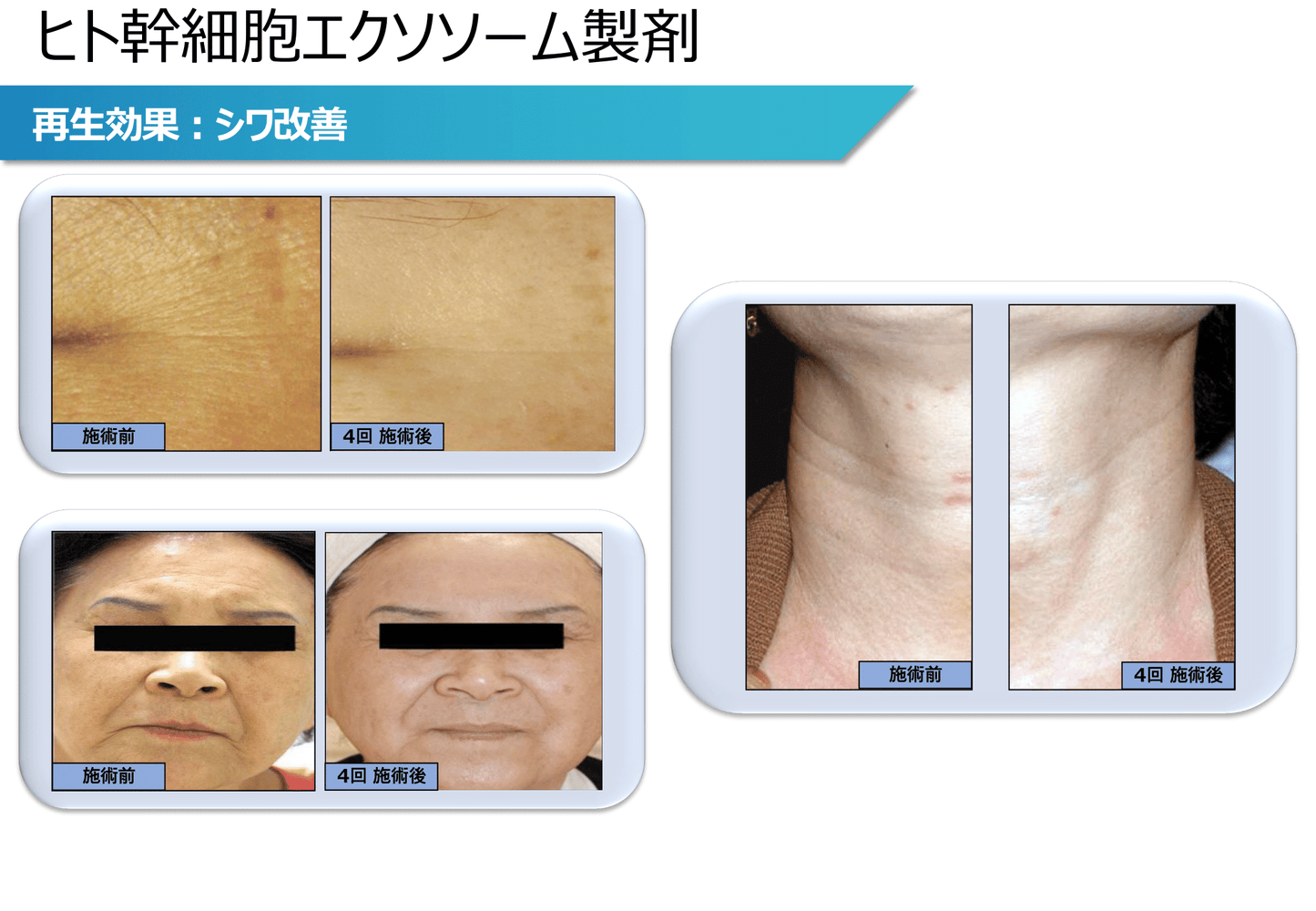 エクソソーム原液5回分+40mlクリーム2本