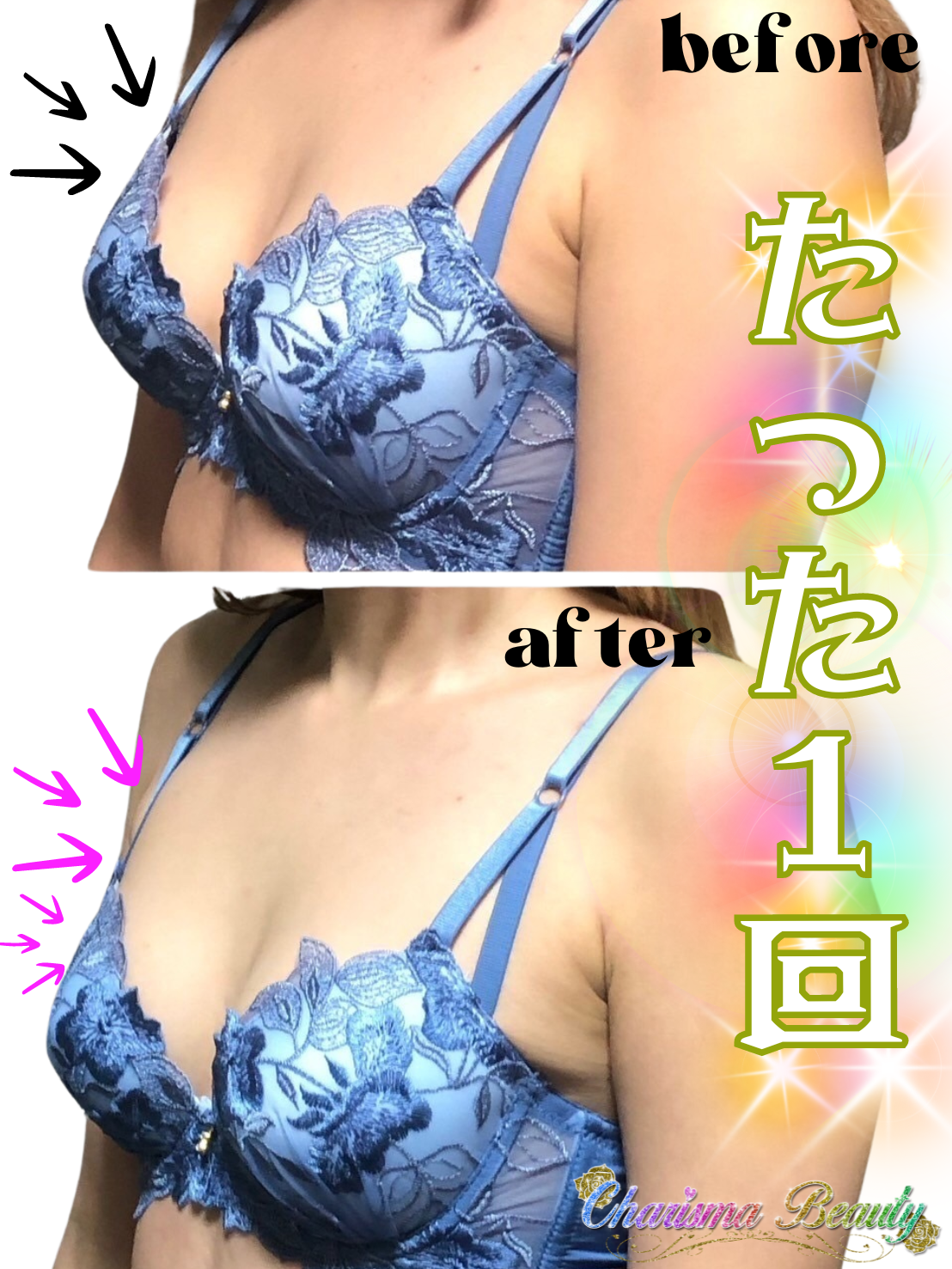 打つ水素 高圧振動波 筋膜リリース