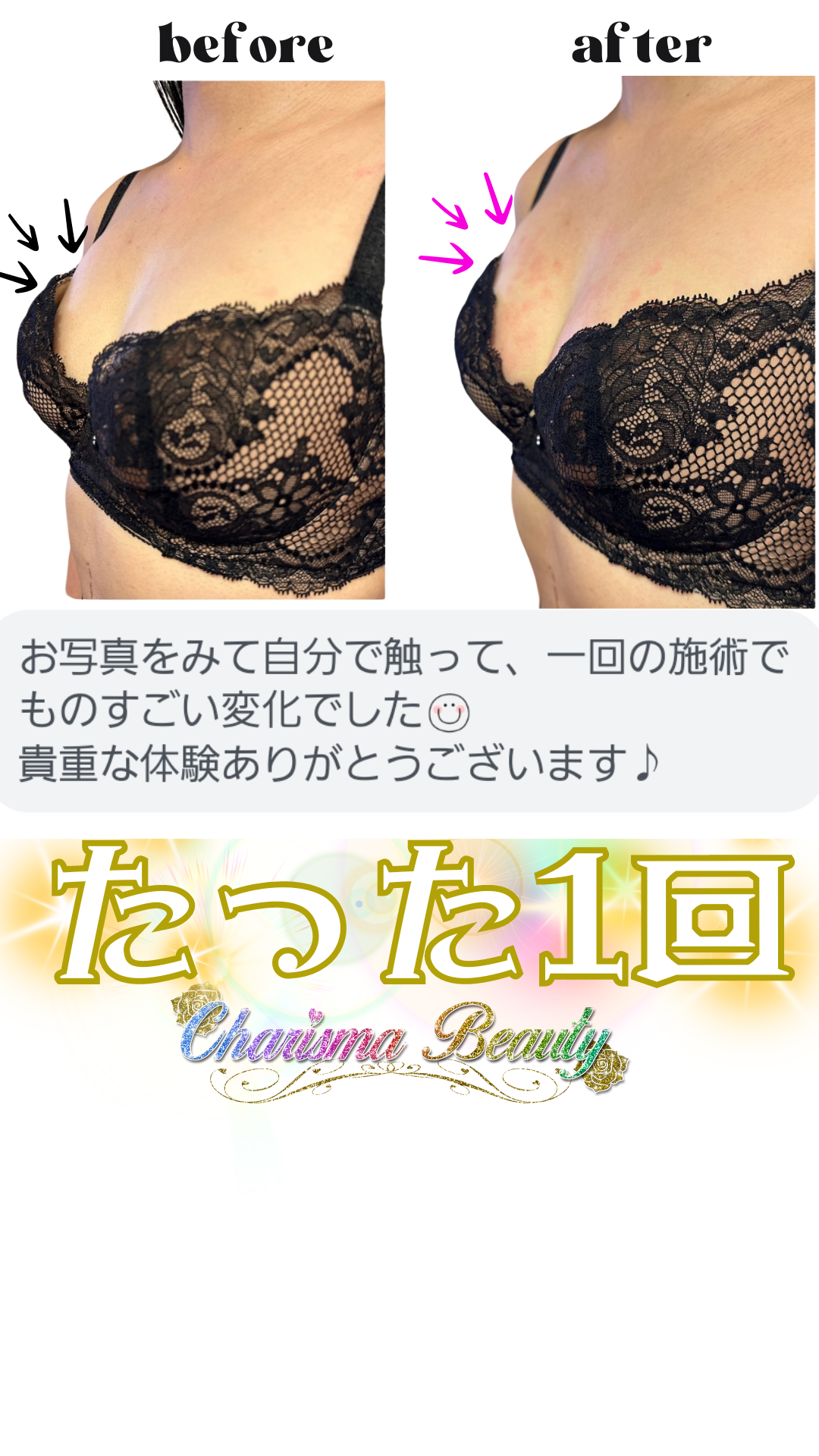 打つ水素 高圧振動波 筋膜リリース