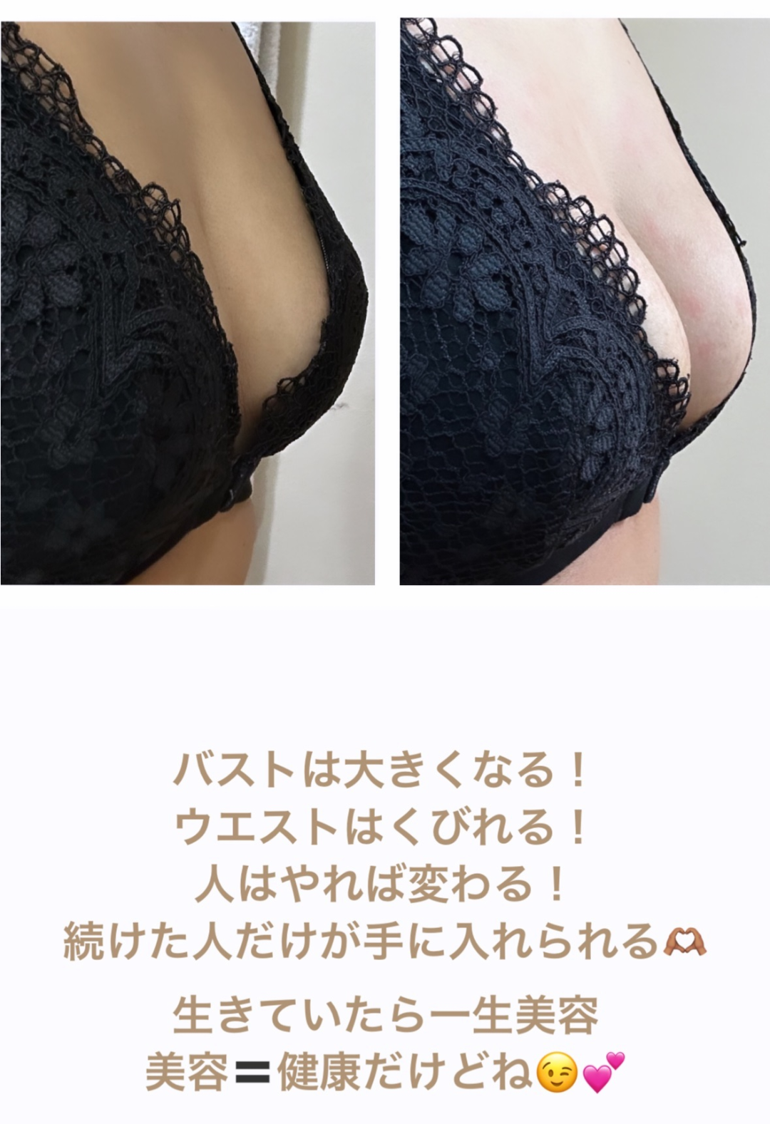 打つ水素 高圧振動波 筋膜リリース