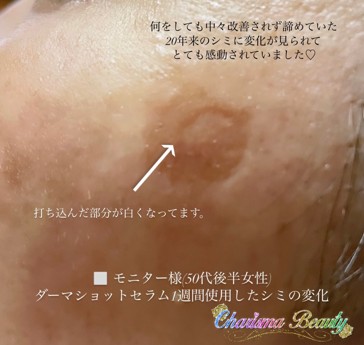 ダーマショットセラム(400shot)